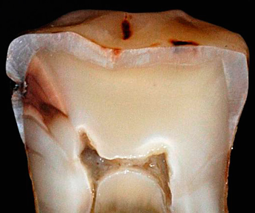 Na časti skutočného zuba je jasne vidieť, ako sa v priebehu času šíri hlboký kaz do buničinovej komory.