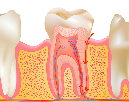La infección pulpar puede ocurrir sin caries, por ejemplo, cuando la infección penetra a través del ápice de la raíz (pulpitis retrógrada).