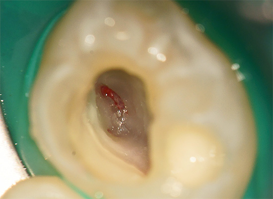 Fotografie ukazuje, že během přípravy zubu byla otevřena dužina.