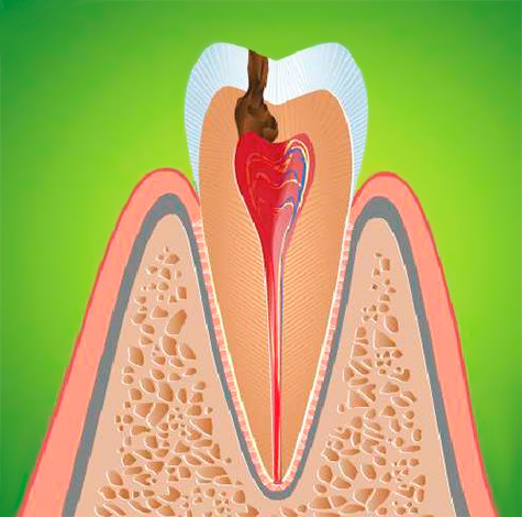 Mjuk vävnadsinflammation i tandens massakammare åtföljs av ett helt komplex av karakteristiska symtom, som vi kommer att överväga ytterligare.
