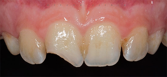 Con una lesión dental grave, a menudo se desarrolla pulpitis traumática.