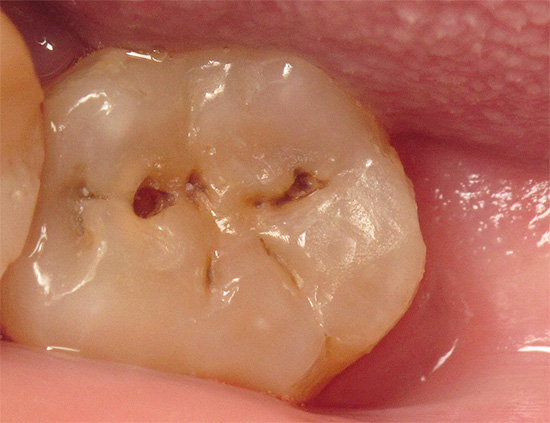 Such a deep caries at any moment can be complicated by pulpitis