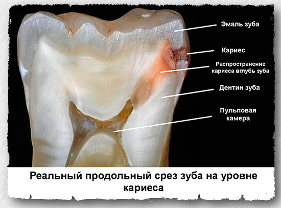 Corte longitudinal de un diente afectado por caries.