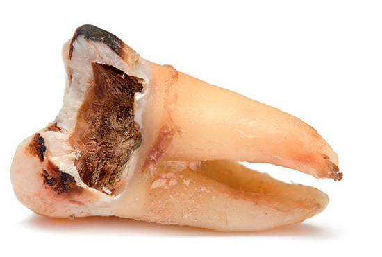 Con varias complicaciones de la pulpitis, el diente a menudo tiene que ser removido.