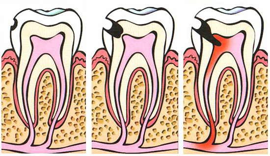 Obrázok schematicky ukazuje vývoj zubného kazu až po pulpitídu