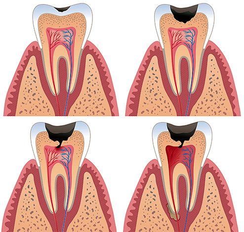 Jei gydymas nebus pradėtas laiku, negyvas danties nervas suskaidys tiesiai pulpos kameroje, o infekcija paveikia dantis supančius audinius.