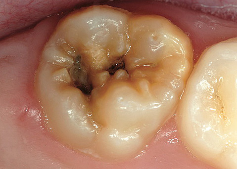 Syvällä kariesilla hampaan sisällä olevaa neurovaskulaarista kimppua suojaavan dentiinikerroksen paksuus on hyvin pieni.