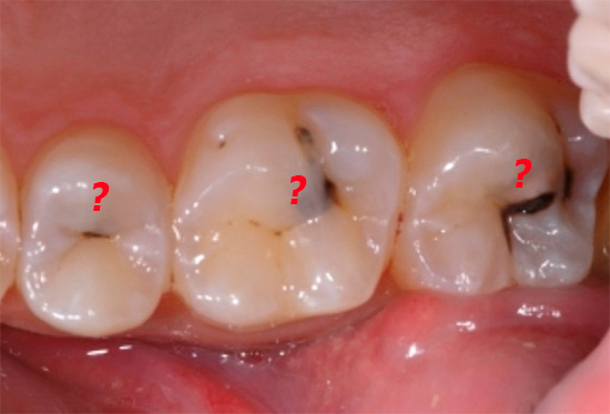 S difuznim pulpitisom, nije uvijek jasno koji određeni zub izaziva akutnu bol.