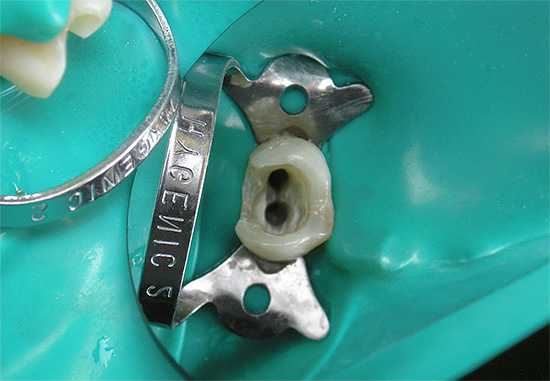 Auf dem Foto ist der Mund der Wurzelkanäle des Zahns deutlich sichtbar