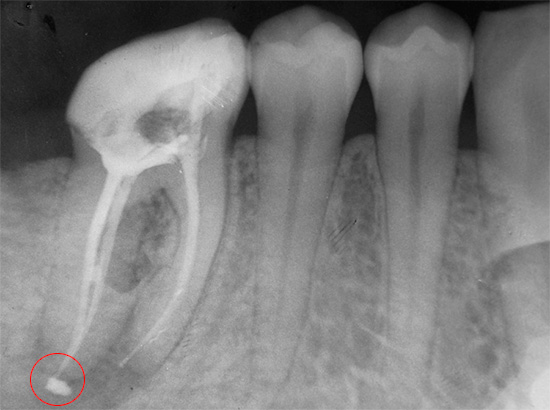 Et eksempel på en forseglet kanal med fjerning av fyllmateriale utover grensen til tannroten inn i tannkjøttet.