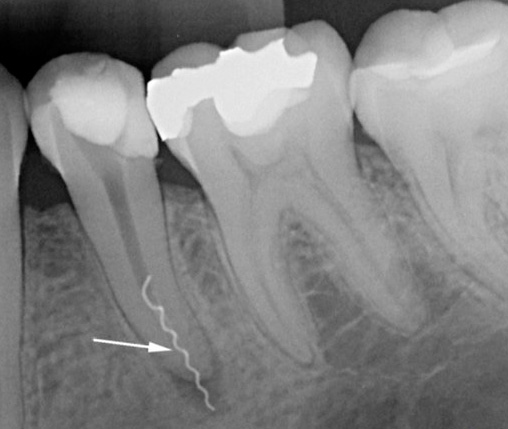 La photographie montre un morceau d'un instrument dentaire cassé dans un canal.