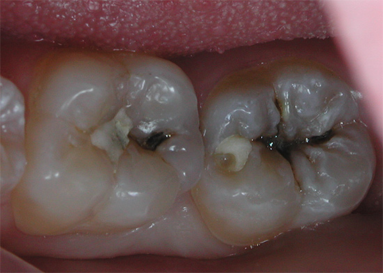 Mâcher des dents avec des caries profondes - les vieilles obturations sont visibles, qui seront enlevées pendant le traitement.