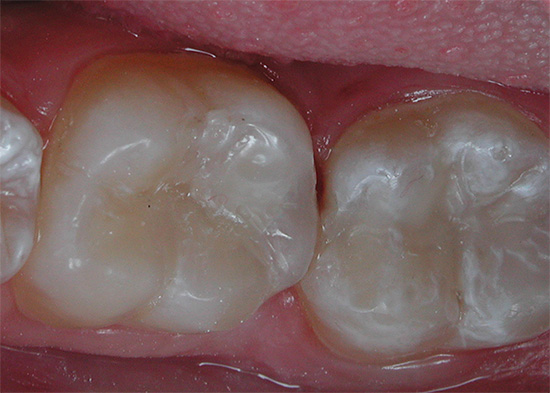Un tāpēc tie paši zobi izskatās pēc ārstēšanas.