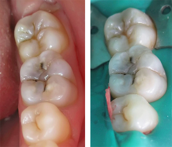 Kesan pada gigi dengan gerudi dan, lebih-lebih lagi, penyingkiran saraf daripadanya adalah sejenis campur tangan pembedahan untuk menghilangkan tisu-tisu yang terinfeksi.