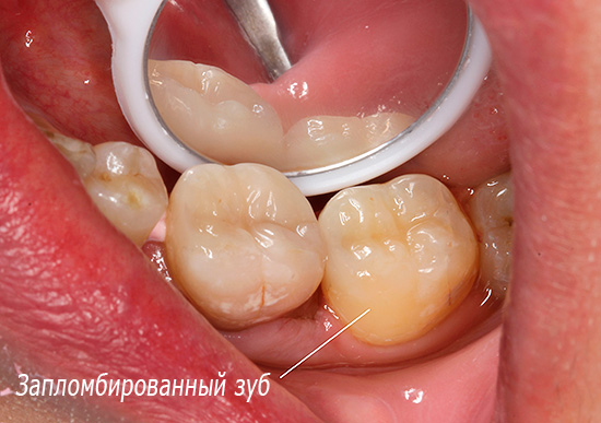 Walaupun selepas rawatan karies cetek, sakit kadang-kadang boleh berlaku di dalam gigi di bawah tampalan.