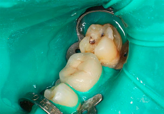 The doctor may make the wrong diagnosis, for example, without recognizing pulpitis against the background of deep caries.