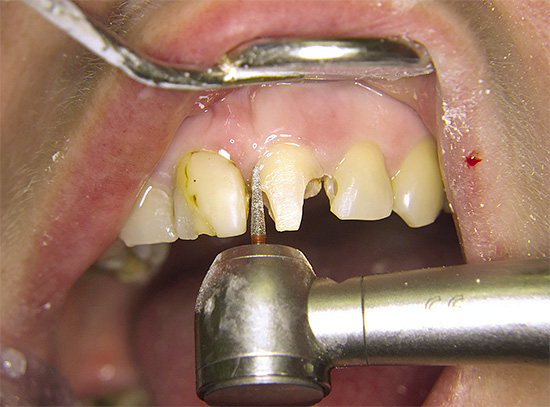 Активното излагане на зъба със свредло без подходящо охлаждане може да доведе до изгаряне на пулпата.