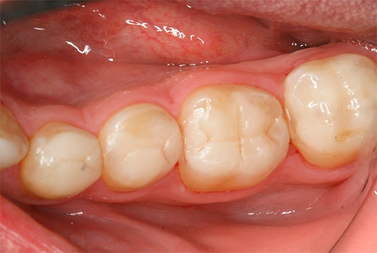 Una mordida de relleno sobreestimada (que interfiere con la mordida) puede provocar lesiones en los tejidos que rodean la raíz del diente.