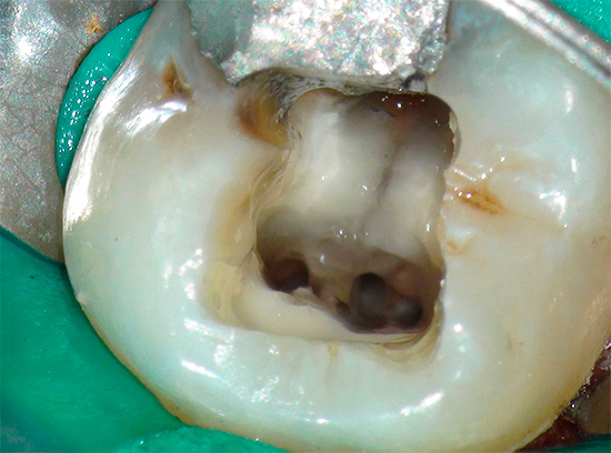 Неки стоматолози сматрају мање болове у зубима након лечења и пуњења канала потпуно природним и прихватљивим.