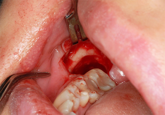 La foto mostra el forat després d’haver tret la dent de saviesa