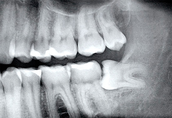 Rentgenowski ząb mądrości jest wyraźnie widoczny na zdjęciu rentgenowskim (jest schowany pod dziąsłem)