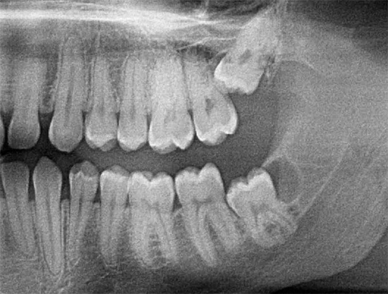 L'image aux rayons X montre les dents de sagesse supérieures et inférieures