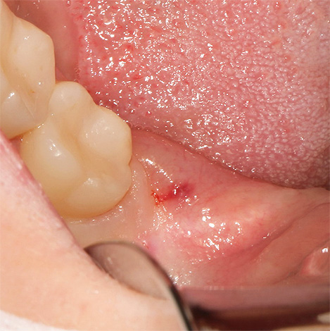 La foto mostra una geniva inflamada amb una dent de saviesa situada a sota seu.