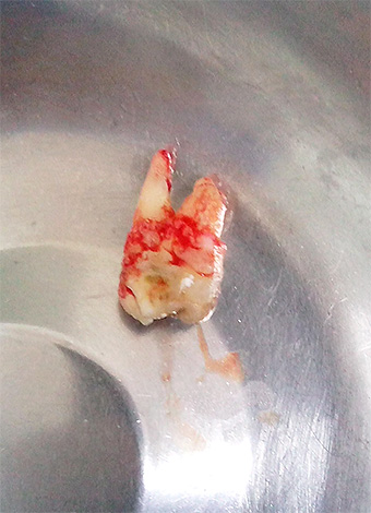 Photo of a removed wisdom tooth in a spittoon