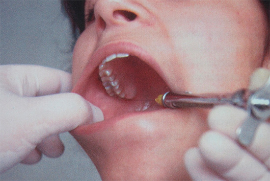 Local anesthesia by gum injection