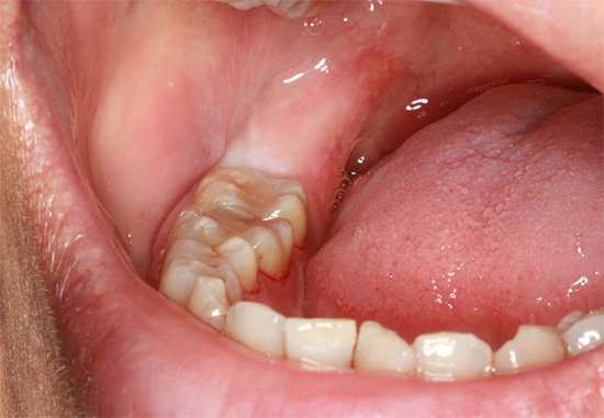 Klinikinis atvejis: išminties dantis dar neišdygo ir yra dantenose.