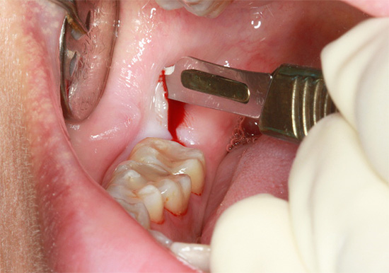 Zahnfleischschnitt