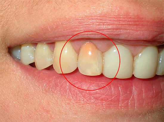 Ružový zub po liečbe pulpitídy metódou rezorcinol-formaldehyd.