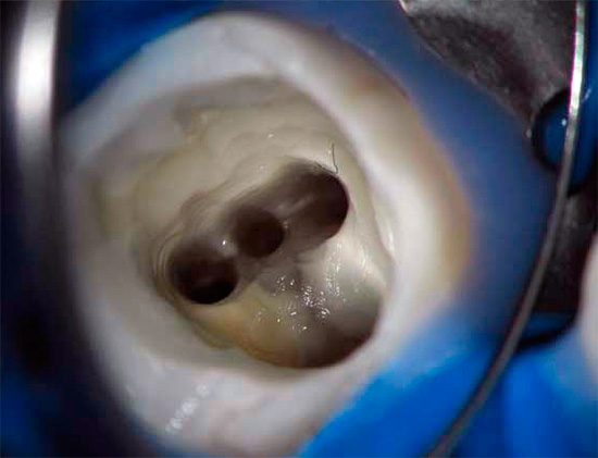 Dalam rawatan pulpitis, sangat penting untuk membersihkan kanal pergigian residu dan jangkitan pulpa.