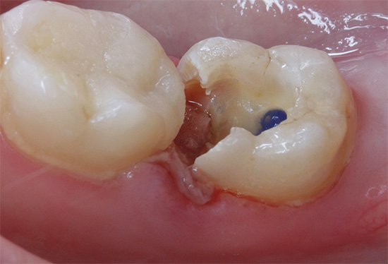 Αυτός είναι ο τρόπος με τον οποίο το δόντι κοιτάει στην αρχή της διαδικασίας θεραπείας - το υλικό εκβραδυνισμού είναι ορατό στο στόμα του ριζικού σωλήνα.