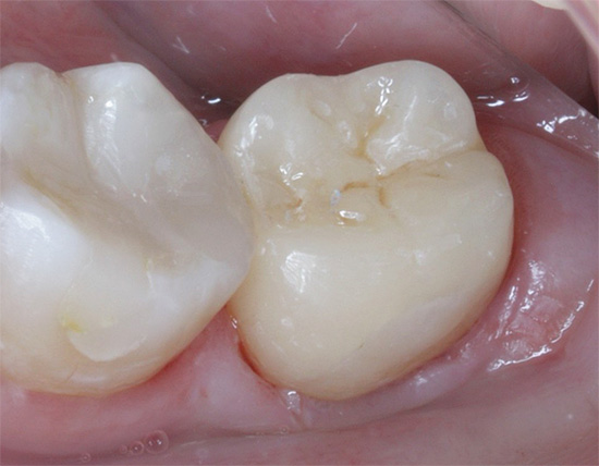 Un tas pats zobs izskatās pēc ārstēšanas.