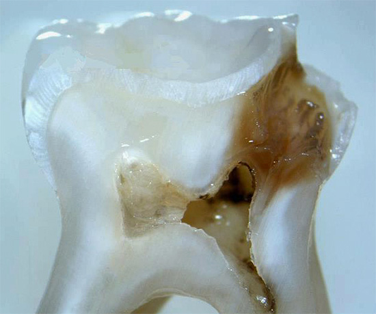 Det kan ses i sektionen att det kariösa hålrummet kom nära tandens massakammare.