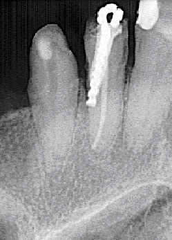 Rentgen ukazuje příklad perforace kořene zubu.