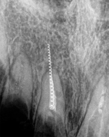 Another shot, on which a broken instrument is clearly visible, stuck in the dental canal with exit beyond the borders of the root of the tooth.