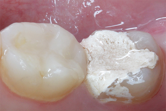 Fotografie ukazuje tzv. Arzén v zubu - dočasné plnění pro zabití nervu.