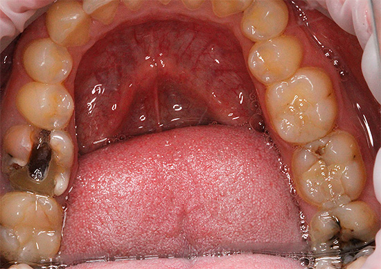 Das Foto zeigt einen Zahn mit einer tiefen kariösen Höhle - in solchen Fällen kann das Spülen manchmal wirklich Schmerzen lindern.