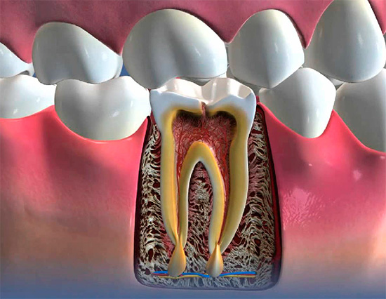 Η εικόνα δείχνει ένα παράδειγμα περιοδοντίτιδας - πυώδη φλεγμονή στη ρίζα του δοντιού.