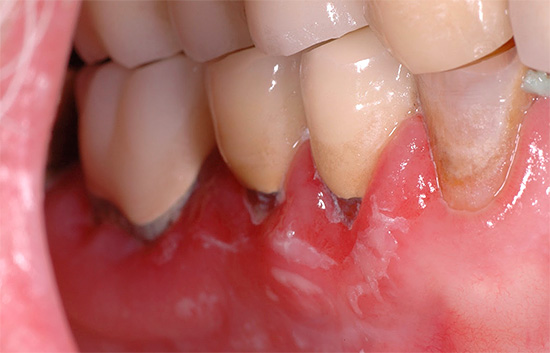 Šilti skalavimai ypač gerai palengvina dantenų ligų skausmus.