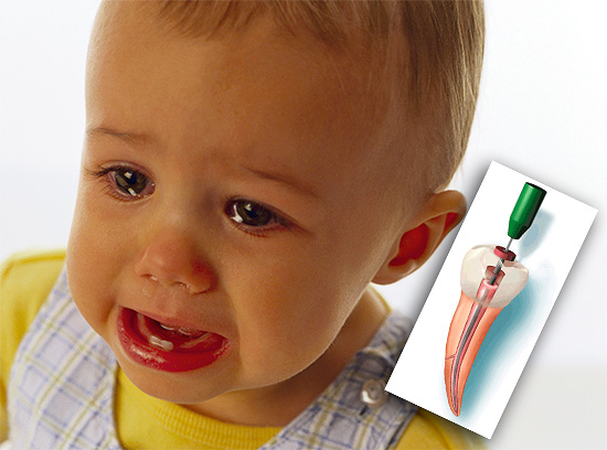 Razmotrimo glavne pristupe liječenju pulpitisa primarnih zuba u dječjoj stomatologiji ...