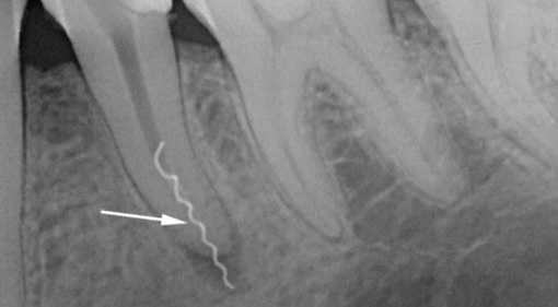 Η ακτινογραφία δείχνει ένα παράδειγμα σπασμένου εργαλείου στο κανάλι ρίζας του δοντιού.
