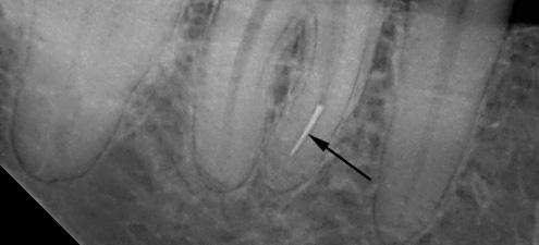 Ødelagte deler av instrumentet i tannkanalen kan senere føre til utvikling av komplikasjoner ...