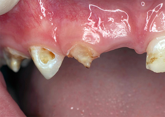 Dans la plupart des cas, la pulpite d'une dent de lait se développe à la suite de caries non guéries à temps.