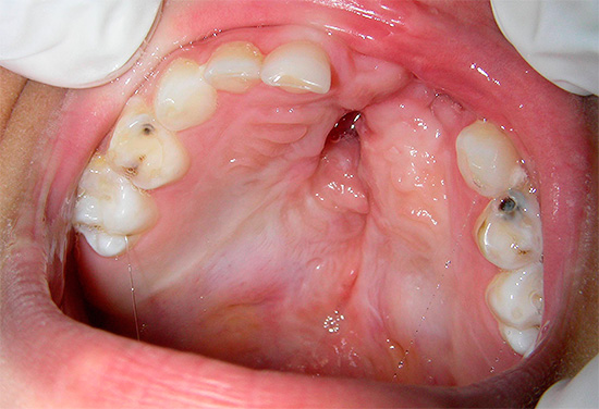 La photo montre une cavité carieuse profonde dans la dent de lait - à travers elle, les bactéries peuvent facilement atteindre la chambre pulpaire.