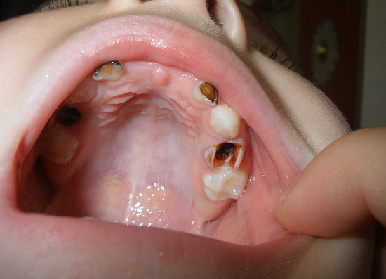 En algunos casos, con pulpitis en un niño, la salud general puede empeorar, aparece dolor en las encías.