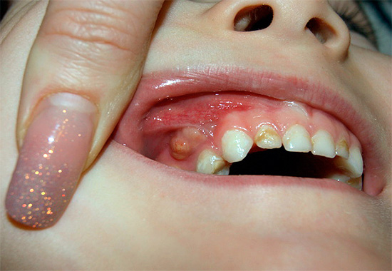 Tandvleesstroom bij een kind