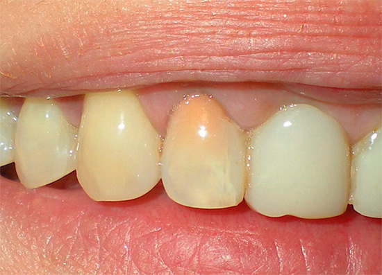 Nach der Behandlung der Pulpitis mit der Resorcin-Formalin-Methode erhält der Zahn eine rosa oder sogar rötliche Farbe.